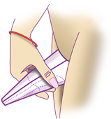 Wee - A Urination Device